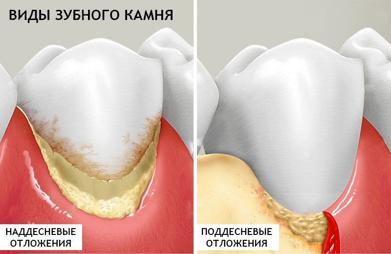 Виды зубного камня