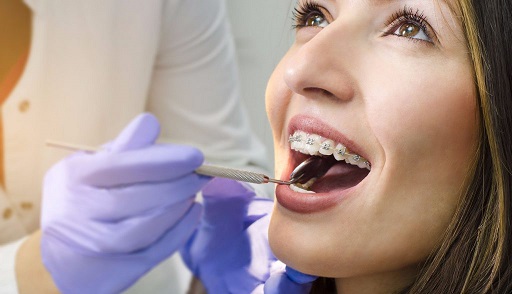 чистка брекет системы у стоматолога.jpg