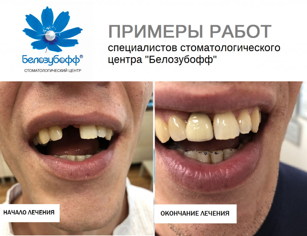 Восстановление зуба Пример работ